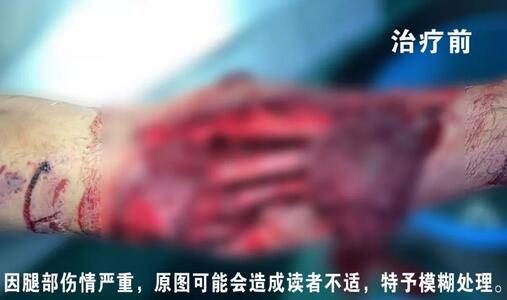 感謝安利醫(yī)院挽救了我的腿，沒(méi)有讓我落下殘疾……”