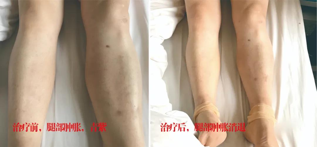 下肢靜脈血栓多年頑疾反復(fù)腫痛——疾病不容等待，早治療，早健康！