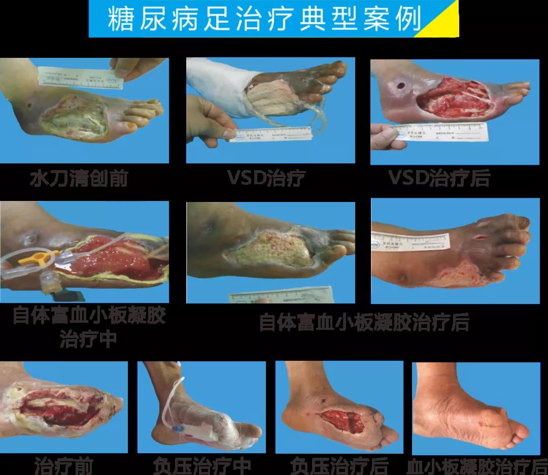 截肢、失明，甚至……，我們要做的是將糖尿病并發(fā)癥遏制在搖籃里！