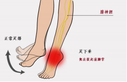 【保山安利醫(yī)院—健康科普】什么是足下垂！你了解嗎？